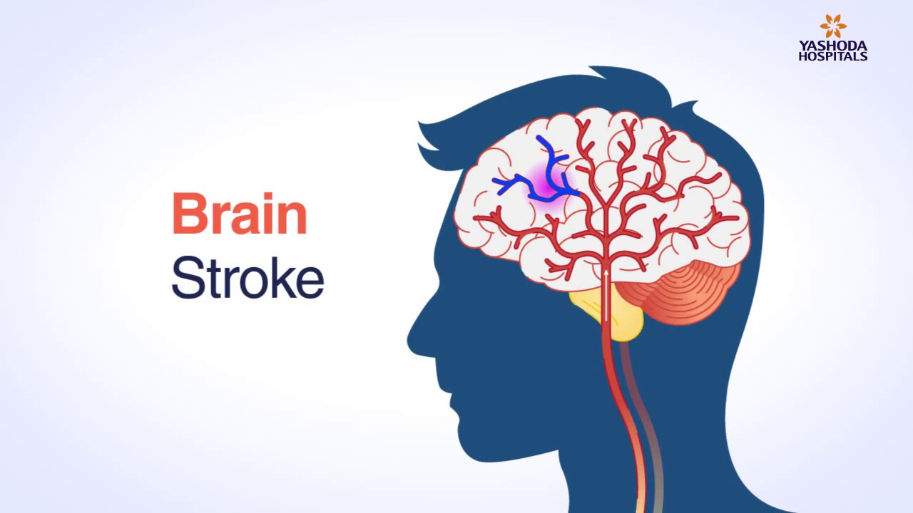 Brain Stroke Types Causes Symptoms Prevention And Treatment