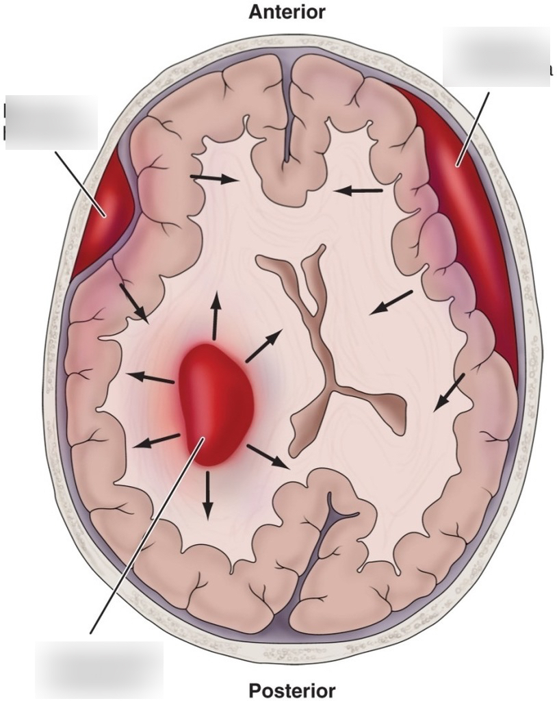 Origins Of Exercises For Intracranial Bleeding: A Historical Overview