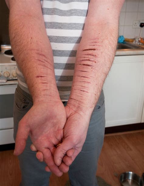 Self Harm On Wrist
