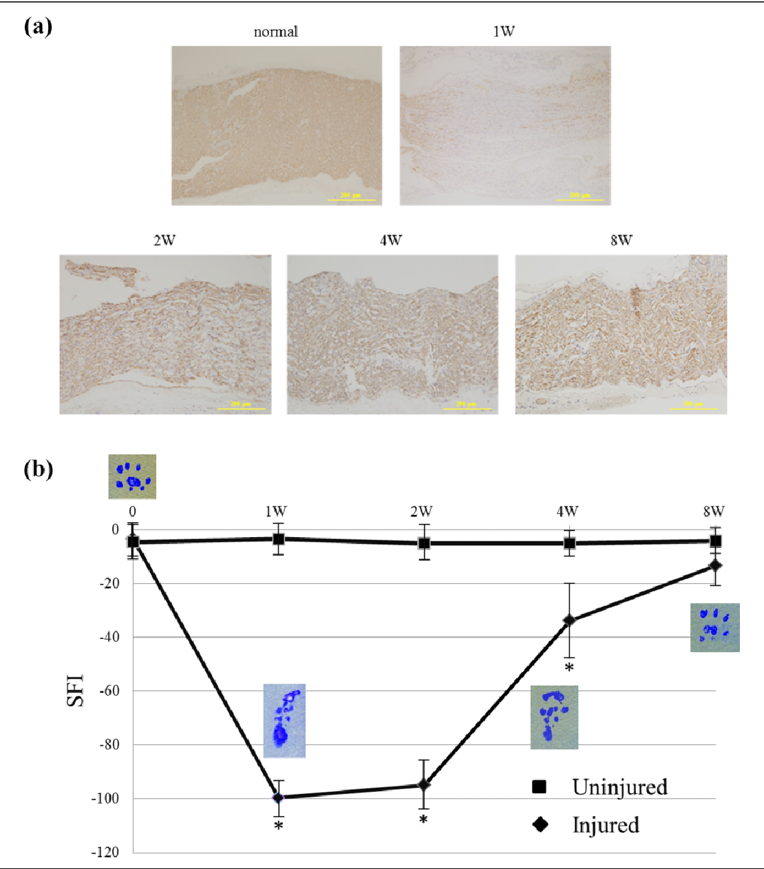Single Cell Analysis Reveals That Gfap Dedifferentiated Schwann Cells Promote Tumor Progress In Pni Positive Distal Cholangiocarcinoma Via Lactate Hmgb1 Axis Cell Death Disease