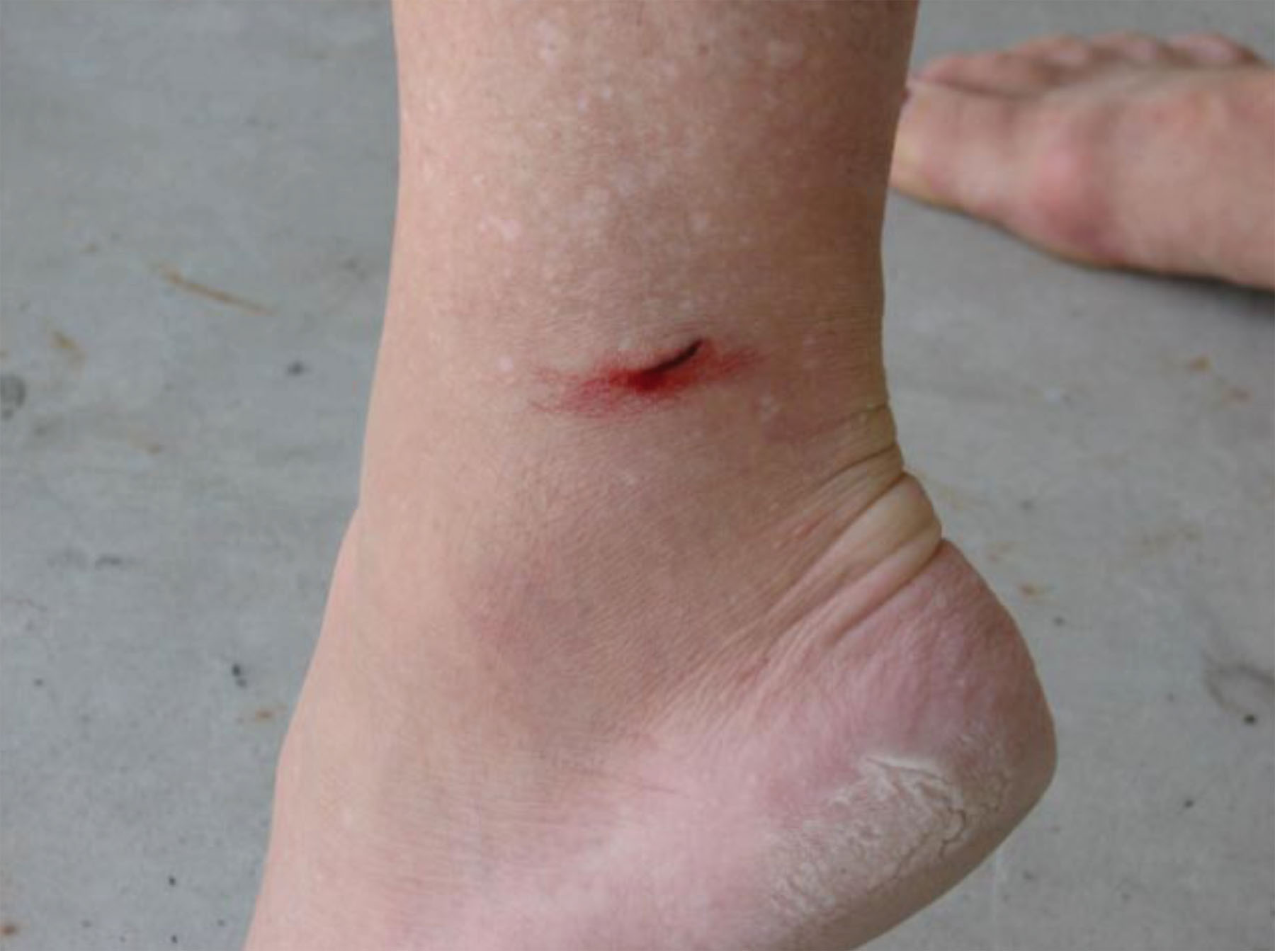 Stingray Sting Foot