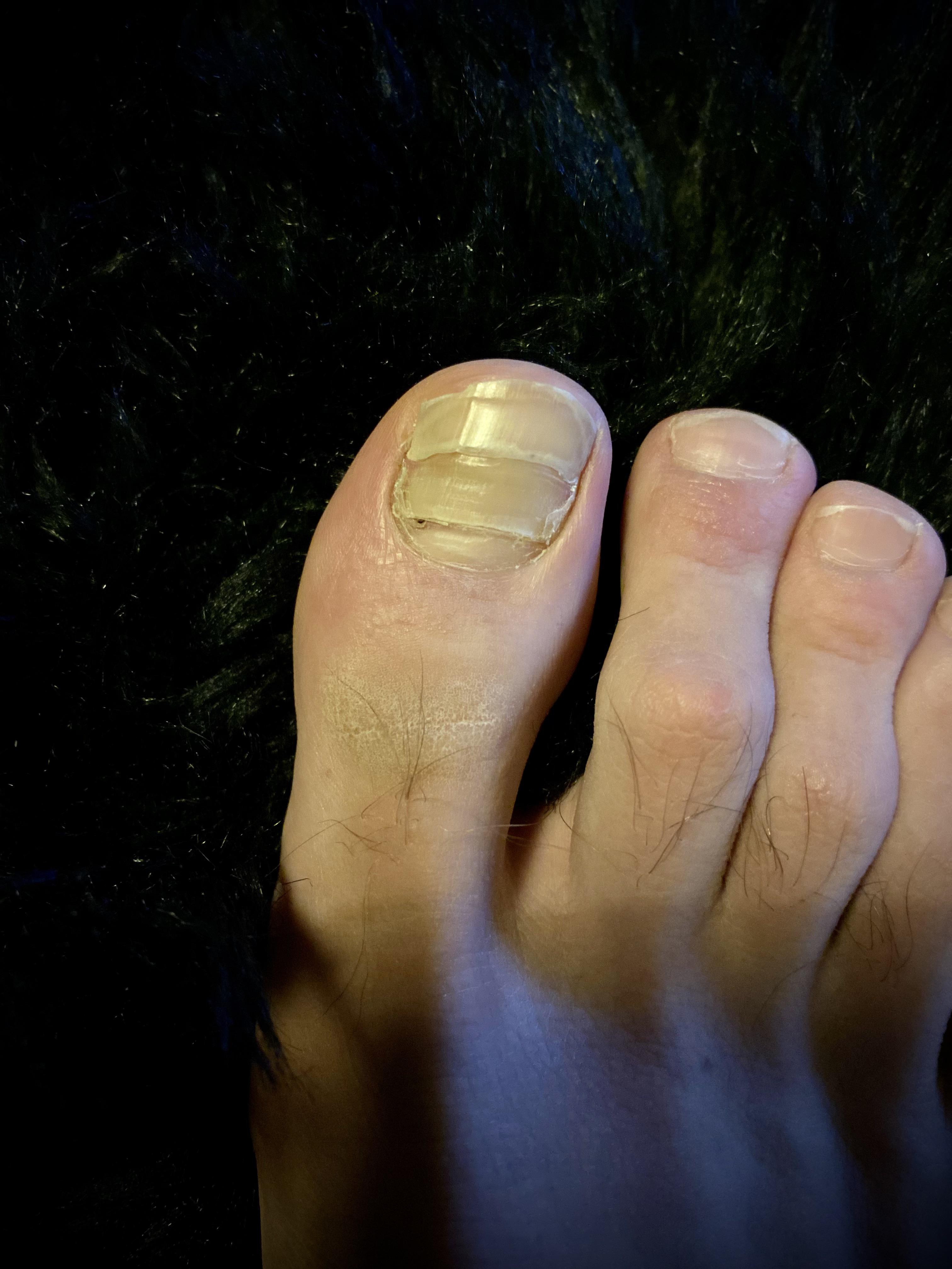 Shocking Fact: Toenail Growing Under Toenail May Signal Infection